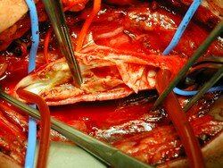 Endarterectomy and shunt: Alternatives or in tandem?